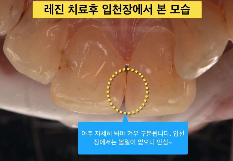 [앞니 레진]레진으로 치아 삭제는 최소화, 결과는 자연스럽게 사진 4