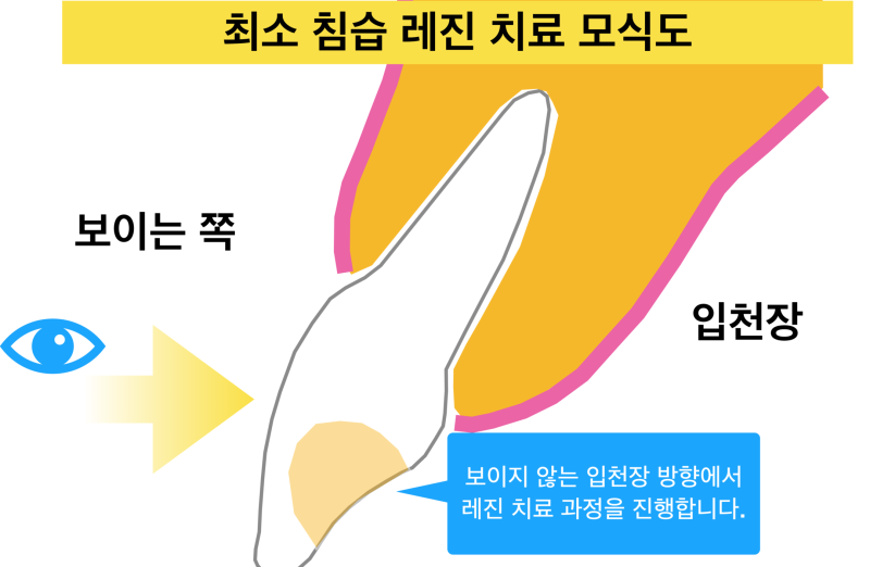 [앞니 레진]레진으로 치아 삭제는 최소화, 결과는 자연스럽게 사진 2