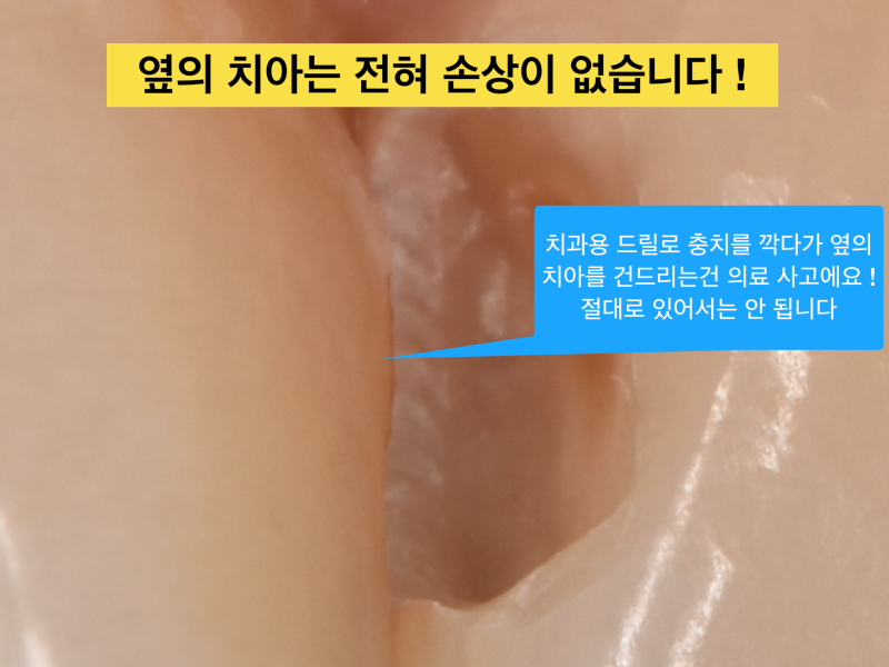 [앞니 레진 치료] 보이는 충치를 레진으로 자연스럽게 치료하기 사진 4