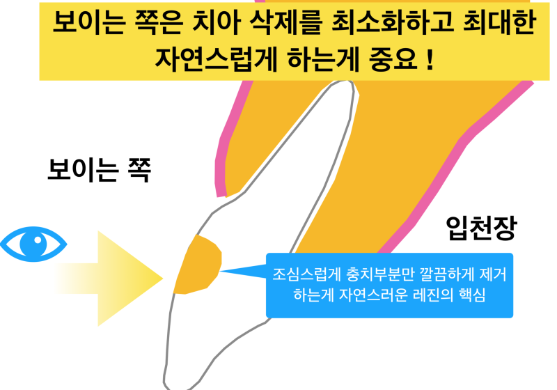 [앞니 레진 치료] 보이는 충치를 레진으로 자연스럽게 치료하기