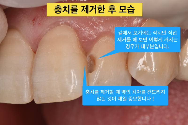 [앞니 레진 치료] 보이는 충치를 레진으로 자연스럽게 치료하기