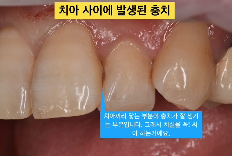 [앞니 레진 치료] 보이는 충치를 레진으로 자연스럽게 치료하기 사진 2