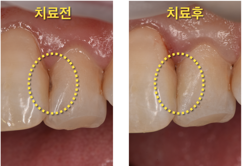 [앞니 레진 치료] 보이는 충치를 레진으로 자연스럽게 치료하기 사진 5