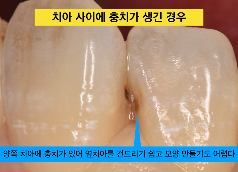 [앞니 레진 치료] 앞니 충치에 매트리스(Matrix)를 써서 옆의 치아를 보호하고 모양은 자연스럽게 레진 치료 하는 방법