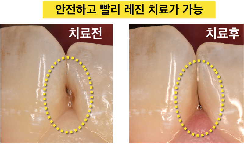 [앞니 레진 치료] 앞니 충치에 매트리스(Matrix)를 써서 옆의 치아를 보호하고 모양은 자연스럽게 레진 치료 하는 방법