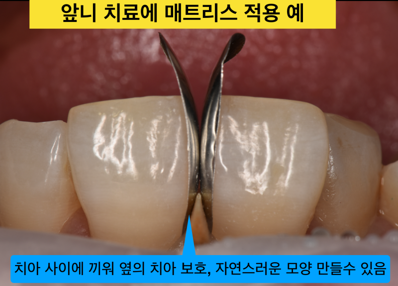 [앞니 레진 치료] 앞니 충치에 매트리스(Matrix)를 써서 옆의 치아를 보호하고 모양은 자연스럽게 레진 치료 하는 방법 사진 3