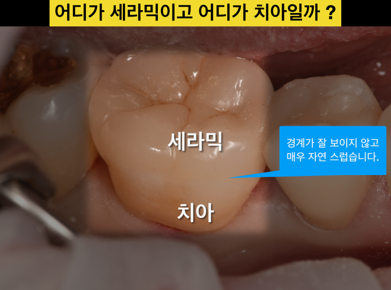 [치과 세라믹 치료]접착 세라믹과 크라운의 차이, 세라믹이 대세인 이유