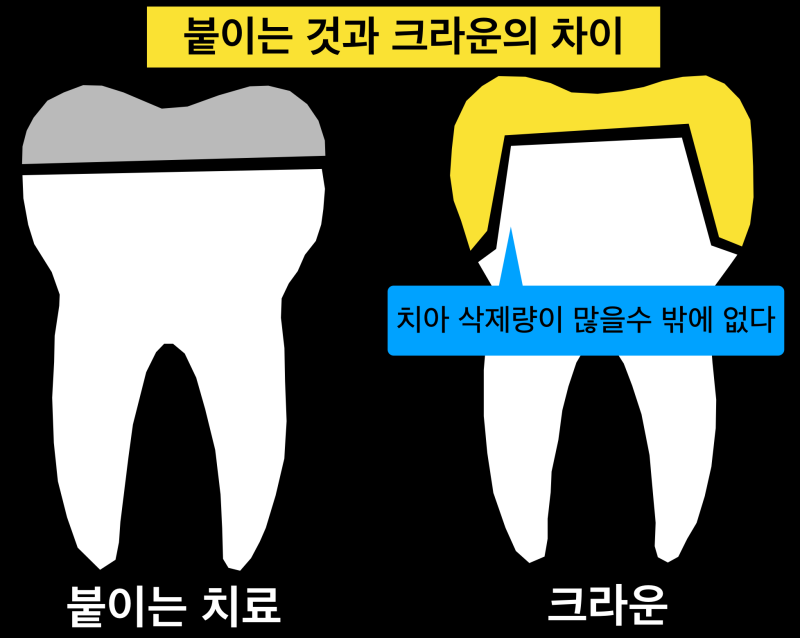 [치과 세라믹 치료]접착 세라믹과 크라운의 차이, 세라믹이 대세인 이유