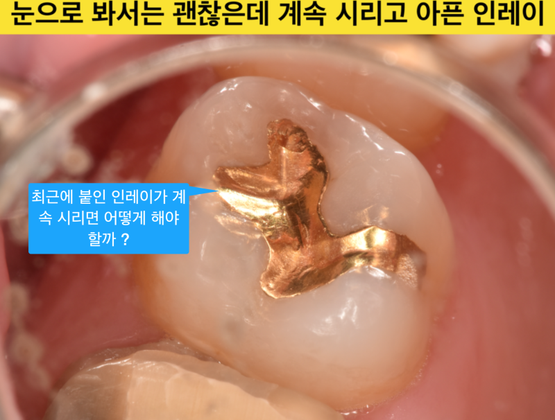 [치과 치료후 통증] 치과 치료를 받았는데 통증이 있는 경우, 없었던애매한 통증이 생겼을 때 사진 2