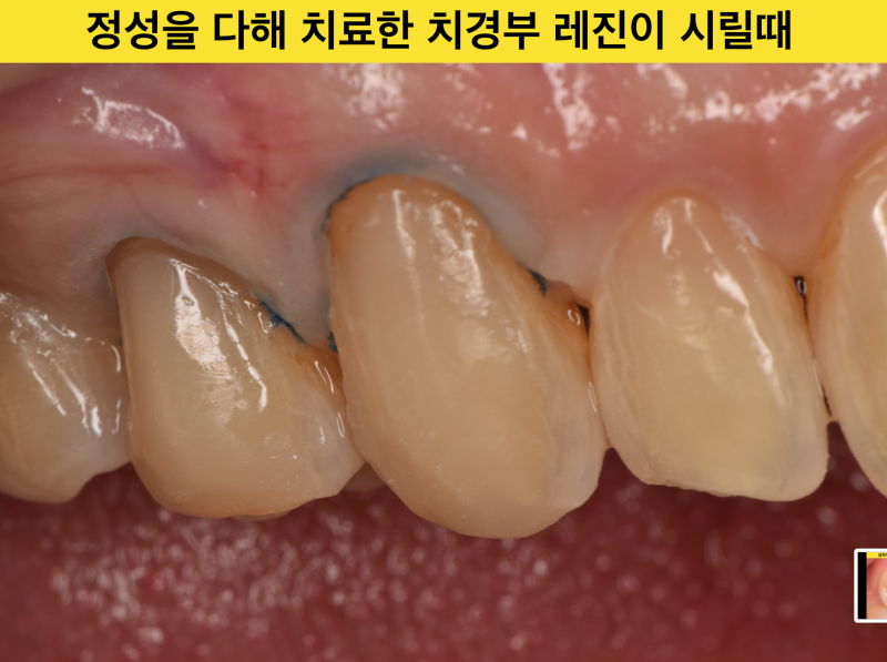 [치과 치료후 통증] 치과 치료를 받았는데 통증이 있는 경우, 없었던애매한 통증이 생겼을 때
