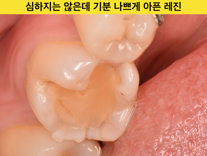 [치과 치료후 통증] 치과 치료를 받았는데 통증이 있는 경우, 없었던애매한 통증이 생겼을 때 사진 3