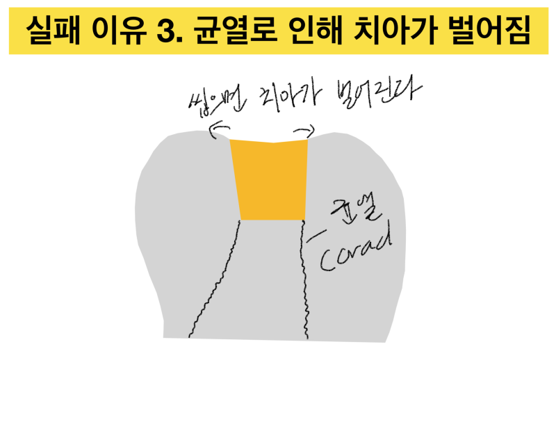 [골드 인레이 이야기] 왜 골드 인레이가 자꾸 떨어질까 ? 골드 인레이실패하는 이유에 대해 설명 드립니다. 사진 4
