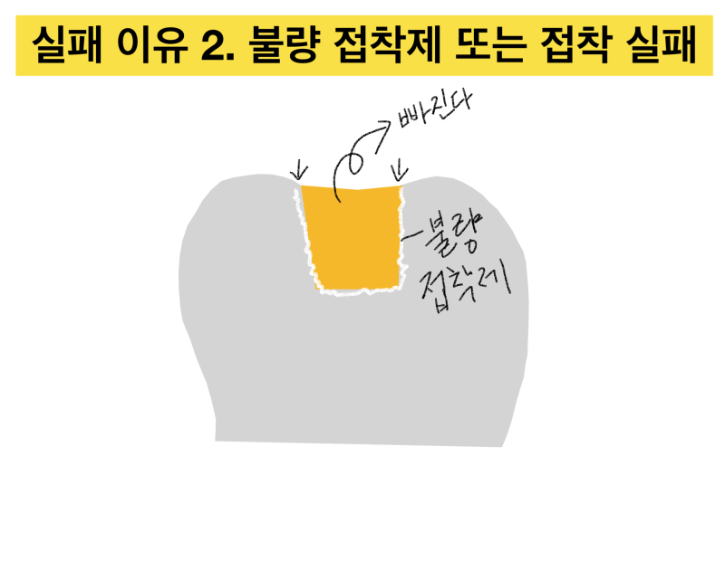 [골드 인레이 이야기] 왜 골드 인레이가 자꾸 떨어질까 ? 골드 인레이실패하는 이유에 대해 설명 드립니다. 사진 3