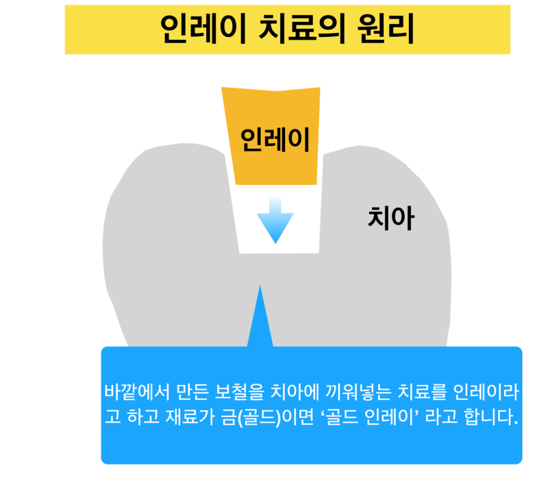 [골드 인레이 이야기] 왜 골드 인레이가 자꾸 떨어질까 ? 골드 인레이실패하는 이유에 대해 설명 드립니다.
