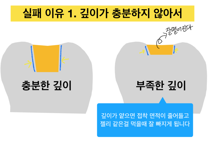 [골드 인레이 이야기] 왜 골드 인레이가 자꾸 떨어질까 ? 골드 인레이실패하는 이유에 대해 설명 드립니다.