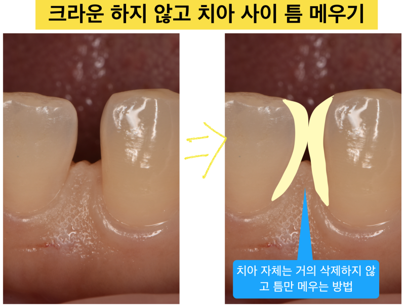 [시리지 않은 레진을 아세요?]앞니 크라운 하지 않고 레진으로 치료하는 방법, 앞니 사이 벌어짐 레진으로 치료 사진 3