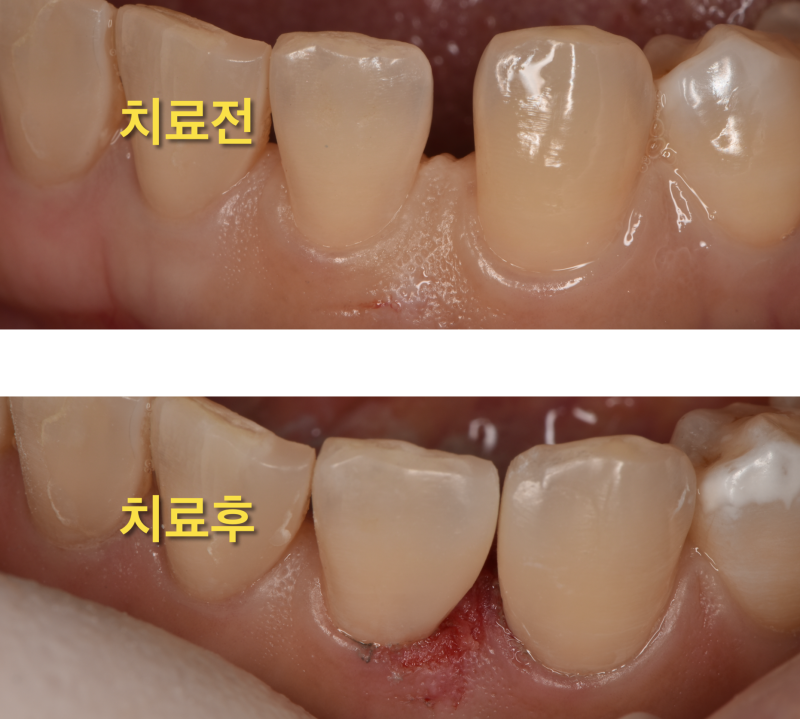 [시리지 않은 레진을 아세요?]앞니 크라운 하지 않고 레진으로 치료하는 방법, 앞니 사이 벌어짐 레진으로 치료 사진 7