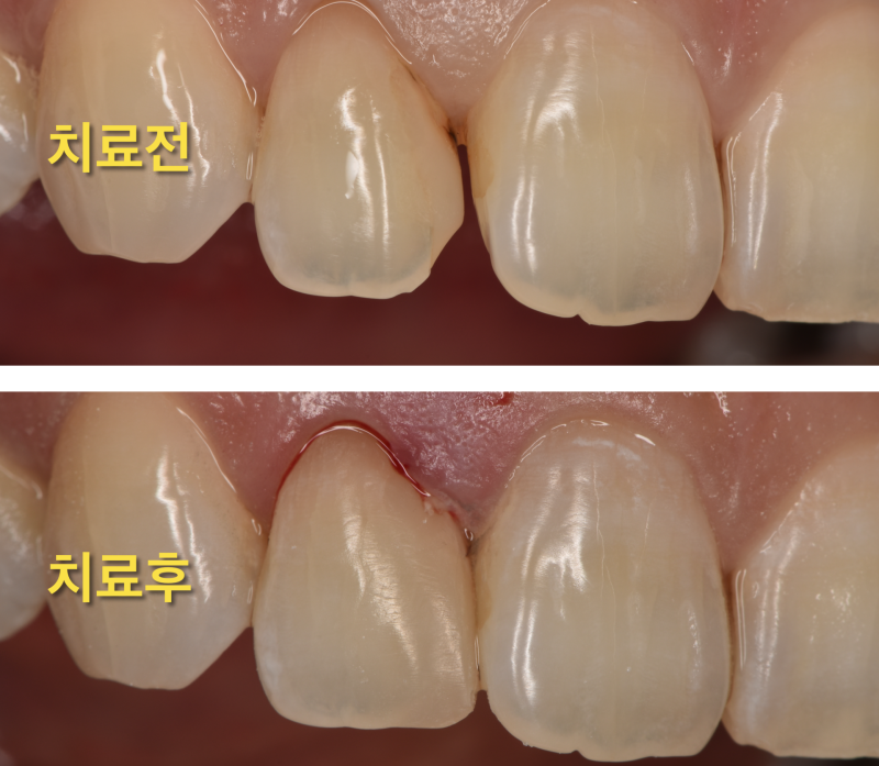 [시리지 않은 레진을 아세요?]앞니 크라운 하지 않고 레진으로 치료하는 방법, 앞니 사이 벌어짐 레진으로 치료 사진 5