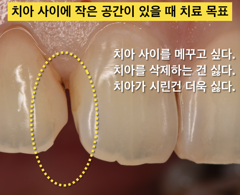 [시리지 않은 레진을 아세요?]앞니 크라운 하지 않고 레진으로 치료하는 방법, 앞니 사이 벌어짐 레진으로 치료 사진 2