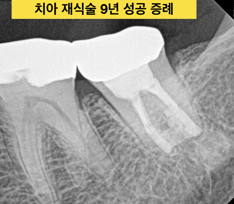 [치아재식술과 치아살리기] 최강아빠가 임플란트를 하지 않는 이유