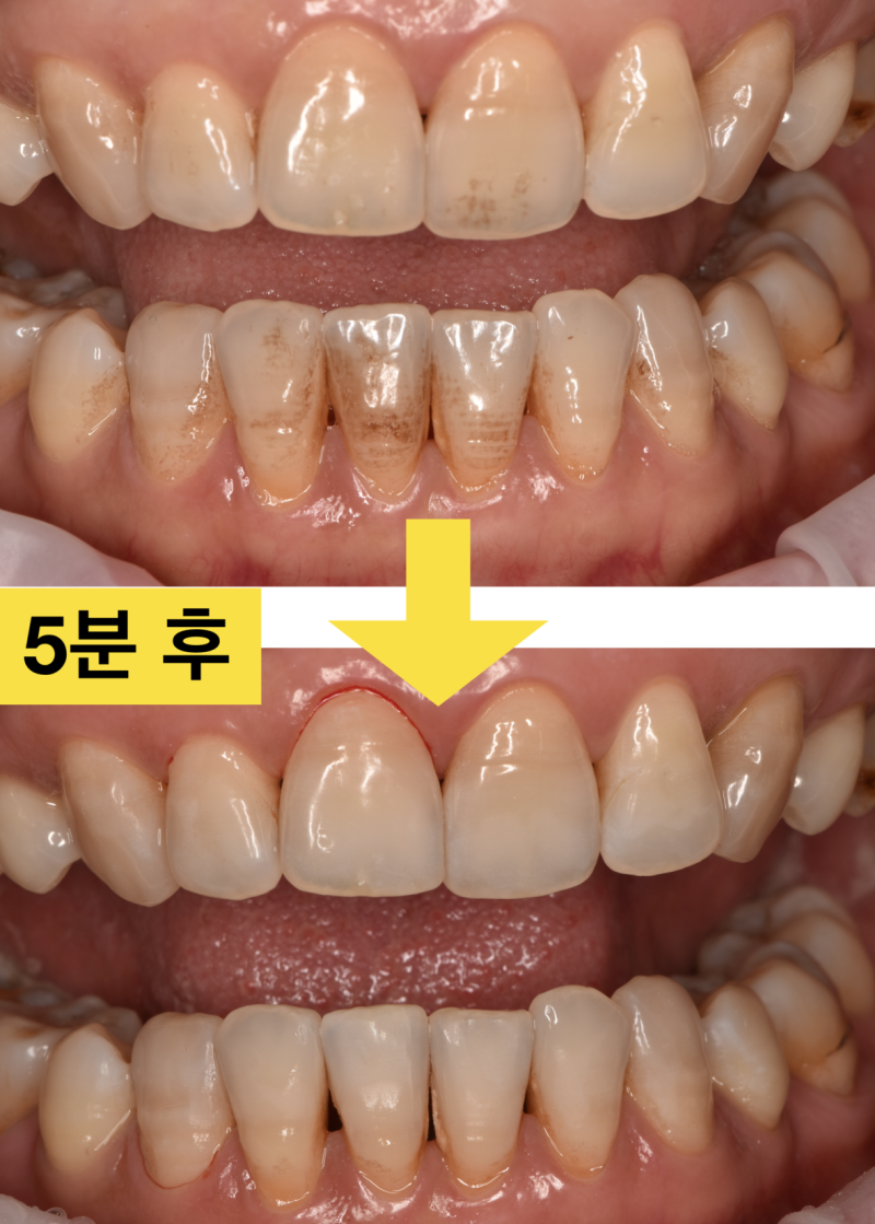 [치아 착색 해결]보기 싫은 치아 착색을 치아 삭제 없이 5분안에 해결 하는 방법 사진 5