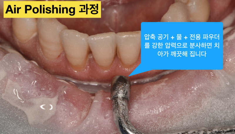 [치아 착색 해결]보기 싫은 치아 착색을 치아 삭제 없이 5분안에 해결 하는 방법 사진 4