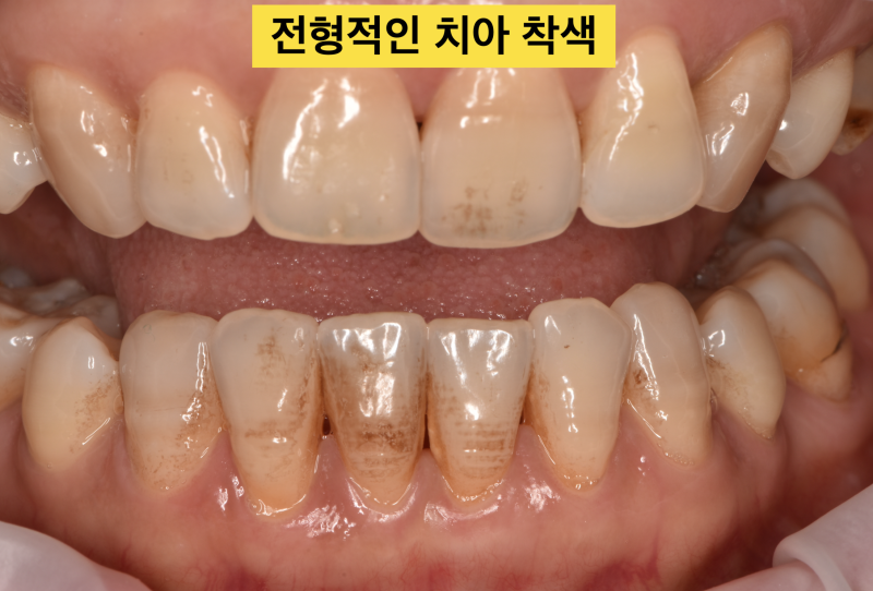 [치아 착색 해결]보기 싫은 치아 착색을 치아 삭제 없이 5분안에 해결 하는 방법 사진 3