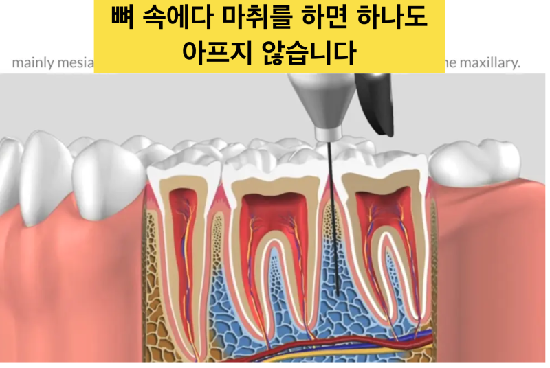 [치과 관계자들 보세요]치과 무통 치료, 안 아프게 치과 마취 받는 방법 사진 4