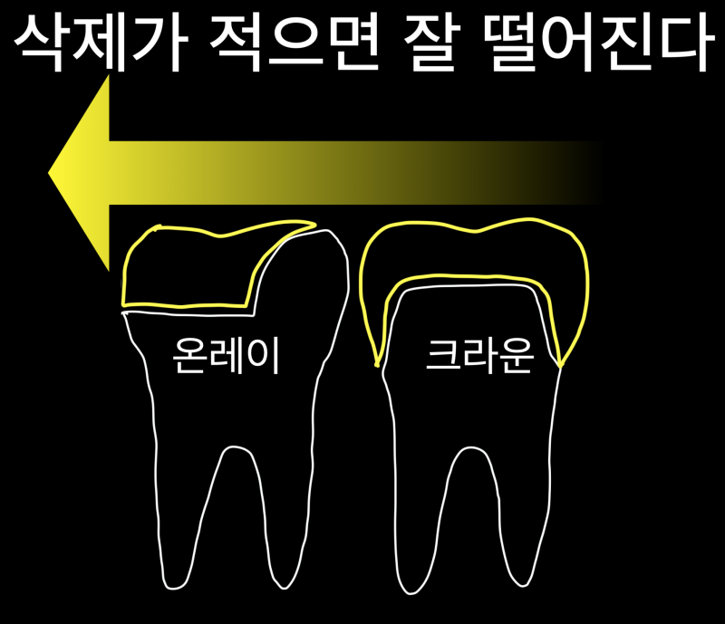 [치과 세라믹 치료]최강 아빠가 접착 세라믹 치료를 선호하는 이유와 접착 과정, 그리고 치과 크라운에 대해서 1편 사진 4