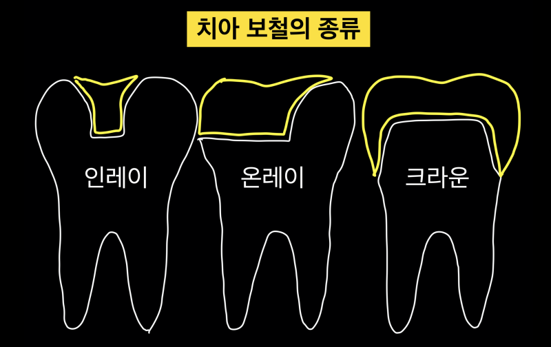 [치과 세라믹 치료]최강 아빠가 접착 세라믹 치료를 선호하는 이유와 접착 과정, 그리고 치과 크라운에 대해서 1편