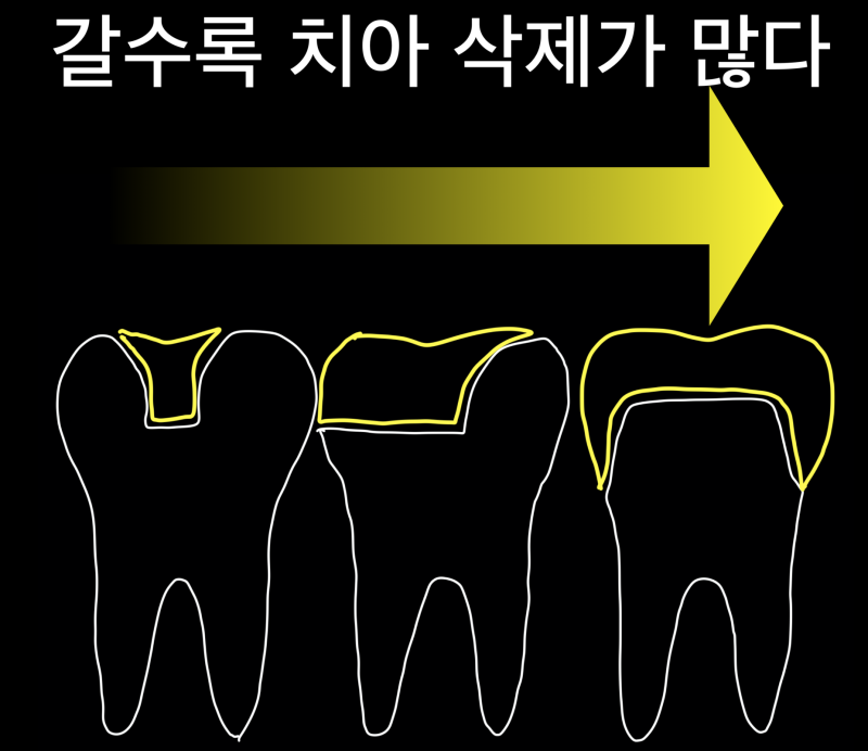 [치과 세라믹 치료]최강 아빠가 접착 세라믹 치료를 선호하는 이유와 접착 과정, 그리고 치과 크라운에 대해서 1편 사진 2