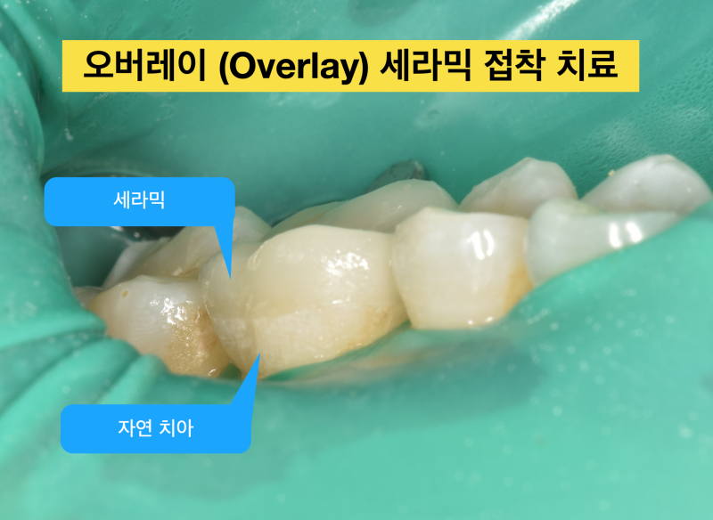 [치과 세라믹 치료]최강 아빠가 접착 세라믹 치료를 선호하는 이유와 접착 과정, 그리고 치과 크라운에 대해서 1편 사진 5