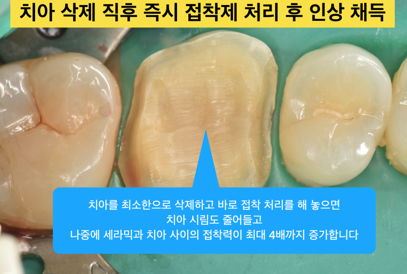 [치과 세라믹 치료] 최강아빠가 접착 세라믹 치료를 선호하는 이유와 접착 과정 2탄