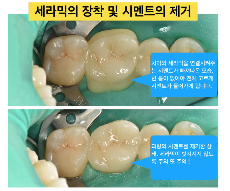 [치과 세라믹 치료] 최강아빠가 접착 세라믹 치료를 선호하는 이유와 접착 과정 2탄 사진 5