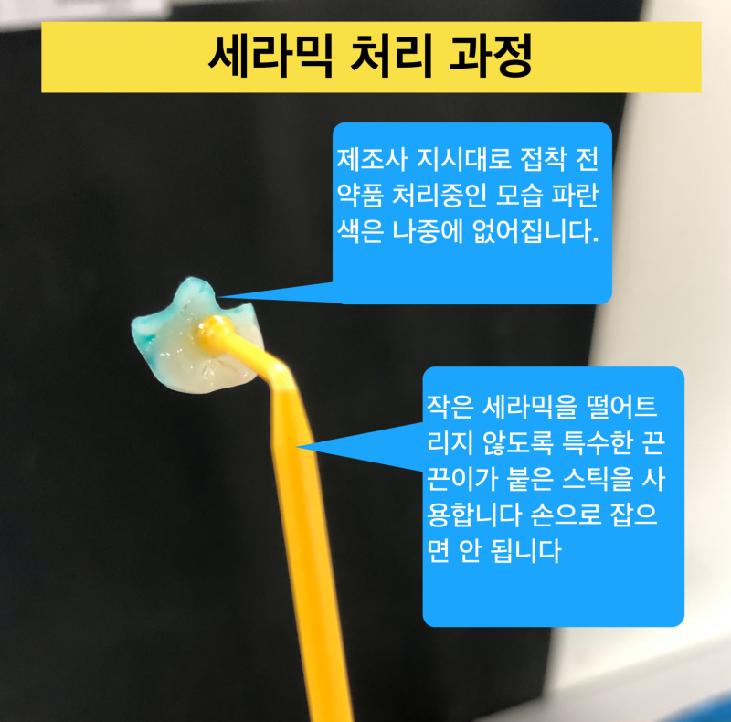 [치과 세라믹 치료] 최강아빠가 접착 세라믹 치료를 선호하는 이유와 접착 과정 2탄 사진 4
