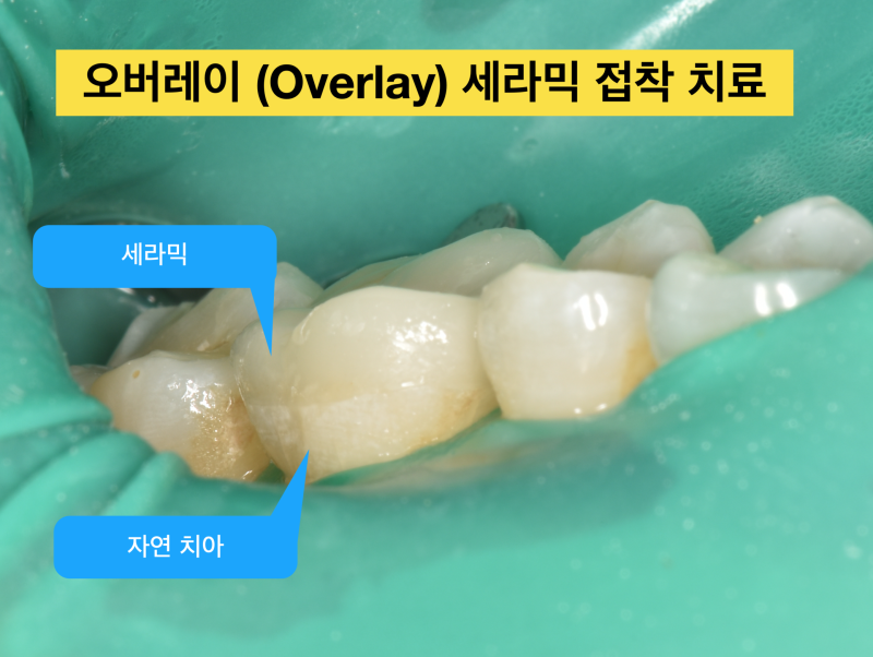 [치과 세라믹 치료] 최강아빠가 접착 세라믹 치료를 선호하는 이유와 접착 과정 2탄 사진 6