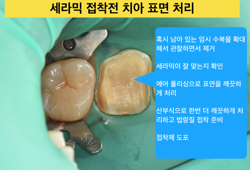 [치과 세라믹 치료] 최강아빠가 접착 세라믹 치료를 선호하는 이유와 접착 과정 2탄 사진 3