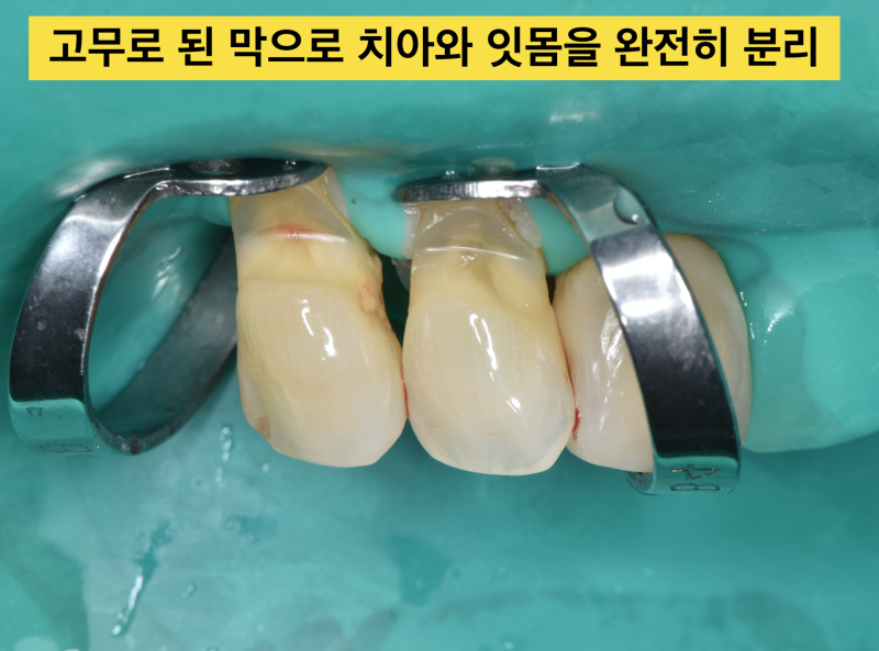 절대 간단하지 않은 치경부마모, 치경부레진치료 실패를 줄이는 방법 사진 3