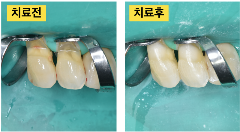 절대 간단하지 않은 치경부마모, 치경부레진치료 실패를 줄이는 방법