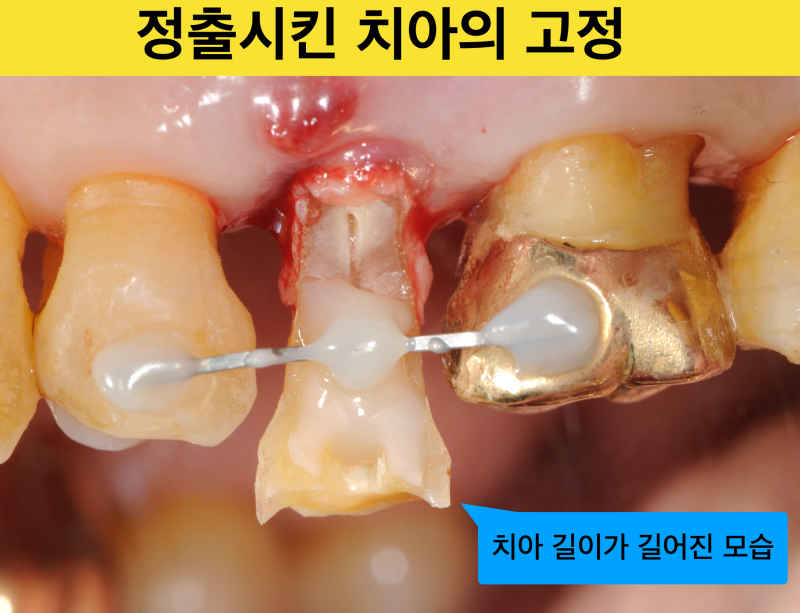 [임플란트를 하기전에] 자연치아를 살리는 치료, 짧은 치아 뿌리를 이용해 치아를 살린 증례 소개 사진 3