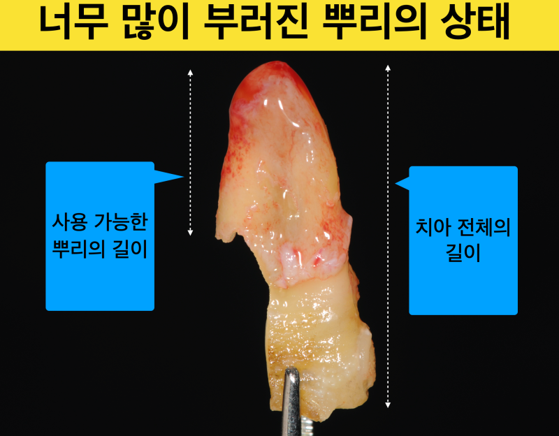 [임플란트를 하기전에] 자연치아를 살리는 치료, 짧은 치아 뿌리를 이용해 치아를 살린 증례 소개 사진 2