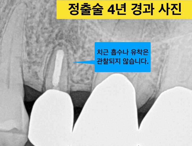[임플란트를 하기전에] 자연치아를 살리는 치료, 짧은 치아 뿌리를 이용해 치아를 살린 증례 소개 사진 6