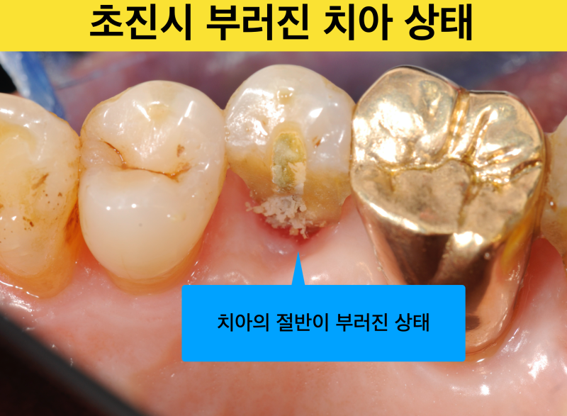 [임플란트를 하기전에] 자연치아를 살리는 치료, 짧은 치아 뿌리를 이용해 치아를 살린 증례 소개