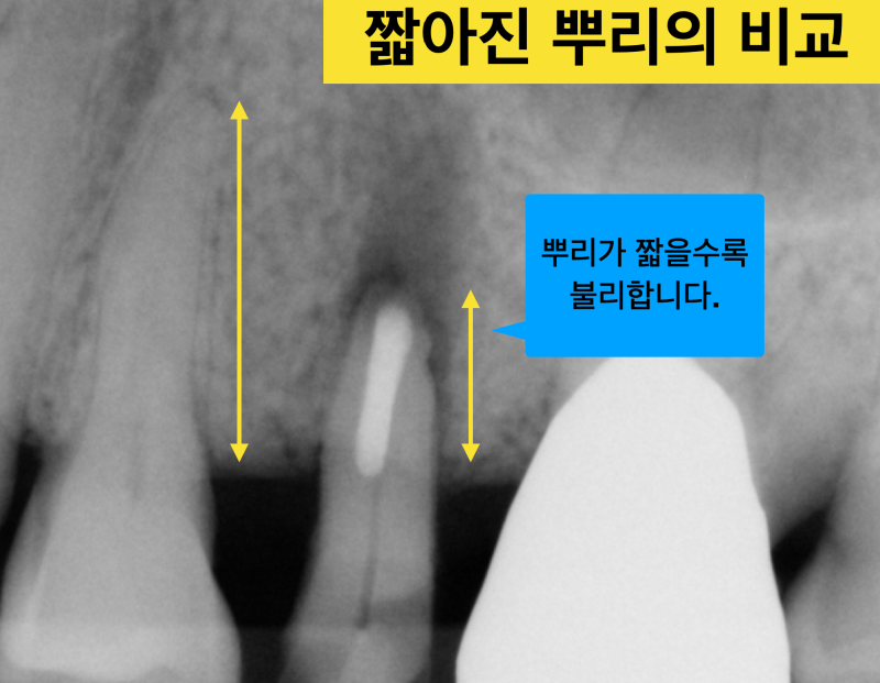 [임플란트를 하기전에] 자연치아를 살리는 치료, 짧은 치아 뿌리를 이용해 치아를 살린 증례 소개 사진 4