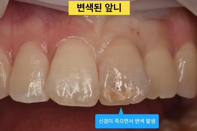 [치아 미백 치료]크라운을 하기전에 치아 미백을 고려해 보자