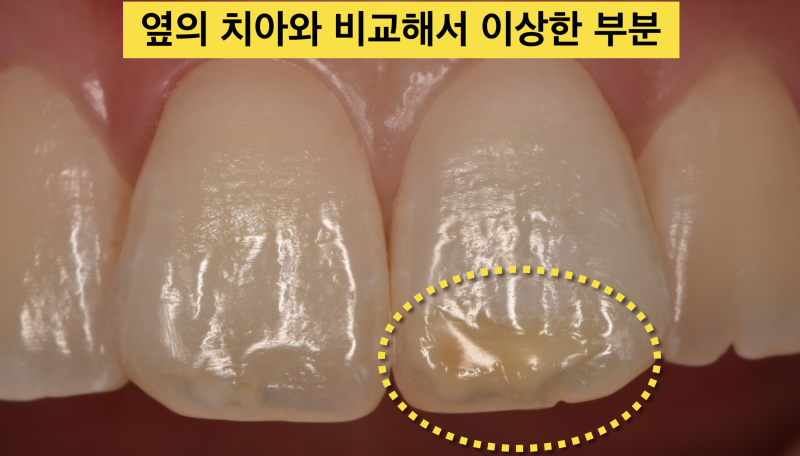[치아 미백 치료]크라운을 하기전에 치아 미백을 고려해 보자