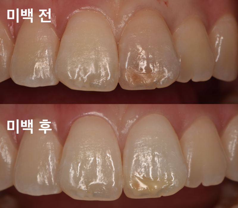 [치아 미백 치료]크라운을 하기전에 치아 미백을 고려해 보자 사진 2