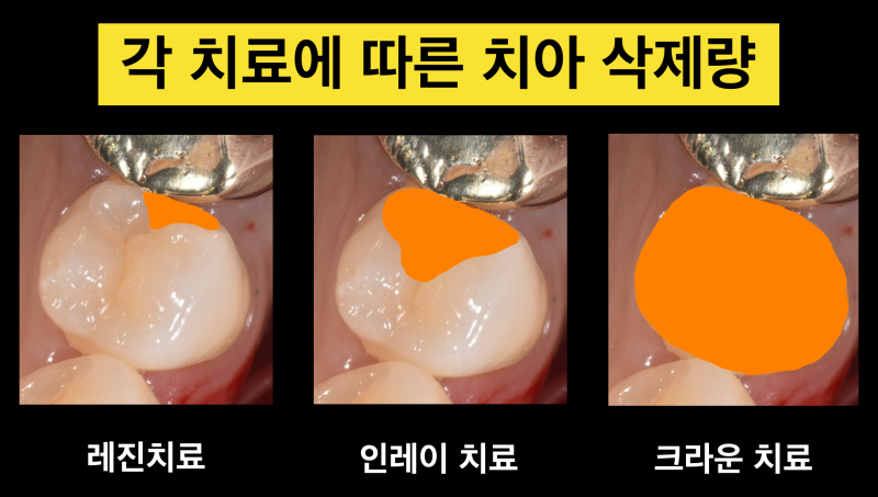 [인접면 레진 치료] 충치가 작은 경우 레진 vs 인레이 vs 크라운 중에 어떤 치료가 좋을까 ?