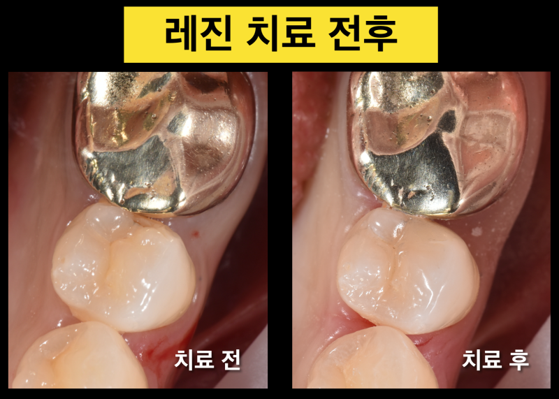[인접면 레진 치료] 충치가 작은 경우 레진 vs 인레이 vs 크라운 중에 어떤 치료가 좋을까 ? 사진 3