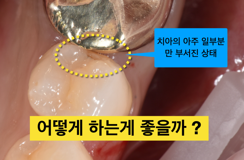 [인접면 레진 치료] 충치가 작은 경우 레진 vs 인레이 vs 크라운 중에 어떤 치료가 좋을까 ?